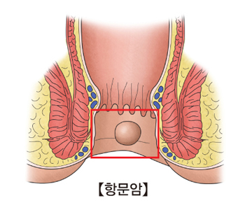 변실금