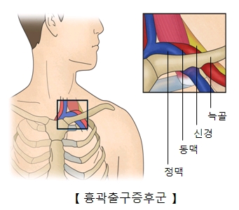 흉곽출구 증후군