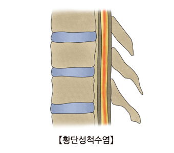 횡단성척수염