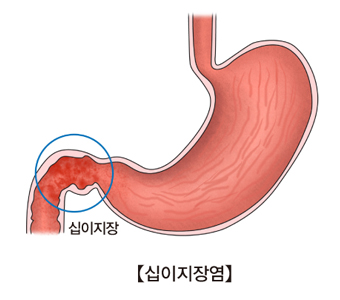 십이지장염