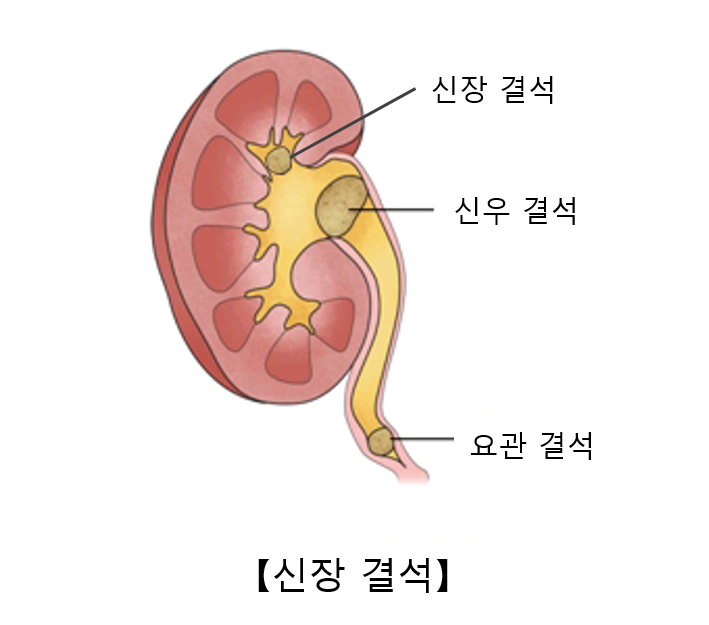 신결석