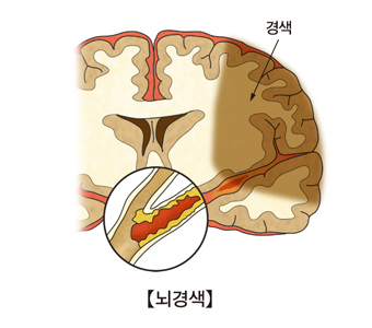 뇌동맥 폐쇄