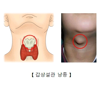 갑상설관낭종