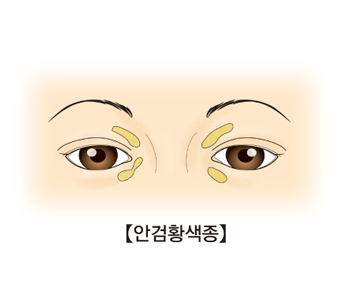 안검황색